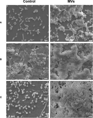 Streptococcus Mutans Membrane Vesicles Enhance Candida albicans Pathogenicity and Carbohydrate Metabolism